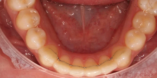 Lower Occlusal After