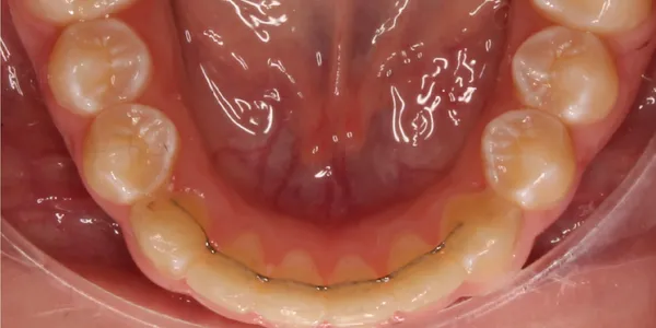 Lower Occlusal After