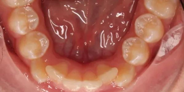 Lower Occlusal Before