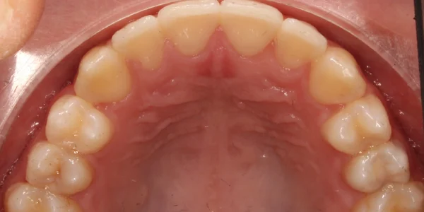 Upper Occlusal After
