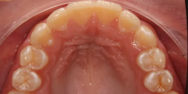 Upper Occlusal After