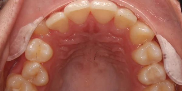 Upper Occlusal Before
