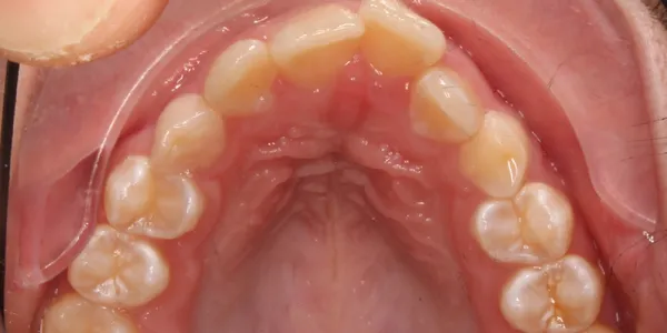 Upper Occlusal Before